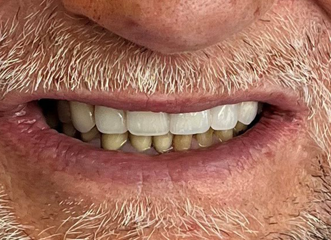 After - The White House Dental