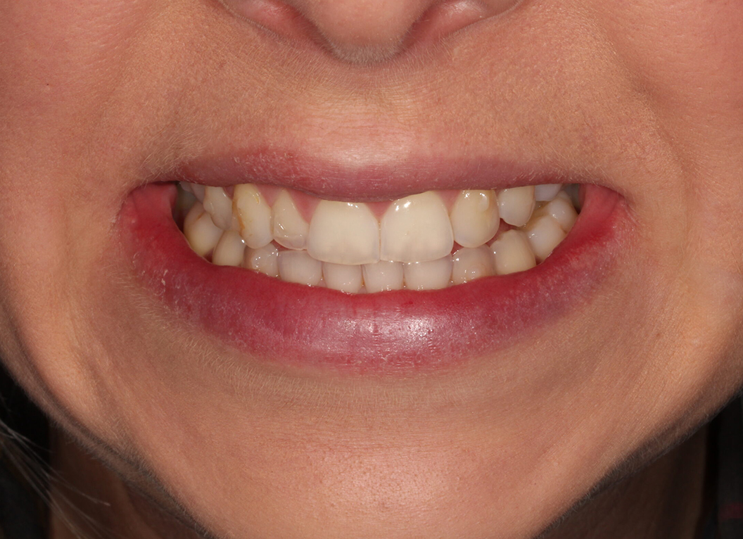 Before - The White House Dental