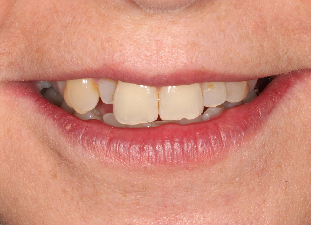 Before - The White House Dental