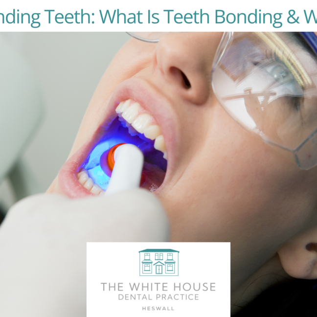 Composite Bonding Teeth What Is Teeth Bonding & What To Expect