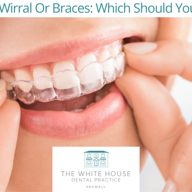 Invisalign Wirral Or Braces: Which Should You Choose?